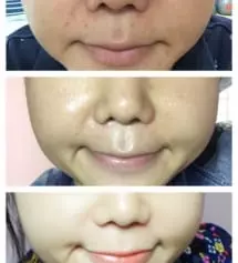 사진이...너무 큰거같은데...이건 무슨 진짜 기적 수준...사람들이 시술 받았냐고 엄청