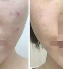 몇년전부터 면역이 떨어지면서 작은 트러블하나라도 건드리면 피부가 재생이 안되고 
