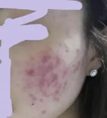 좀 징그러울수도있지만..그래도 이런 후기는 사진을 남겨야될것같아서 ㅠ..올리게 됐습