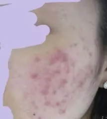 좀 징그러울수도있지만..그래도 이런 후기는 사진을 남겨야될것같아서 ㅠ..올리게 됐습