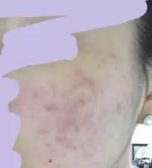 좀 징그러울수도있지만..그래도 이런 후기는 사진을 남겨야될것같아서 ㅠ..올리게 됐습