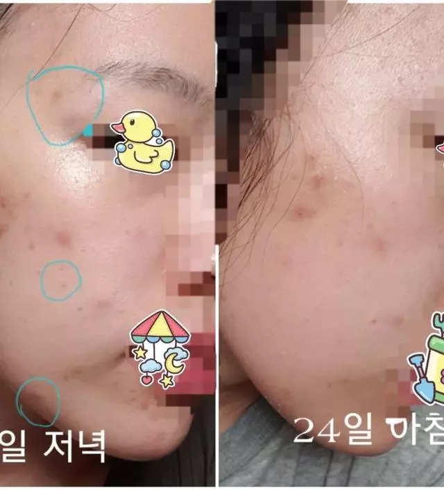 아침 저녁으로 발라준뒤 사진도 하루 아침 저녁으로 찍어서 정말 아이소이는 효과다 라