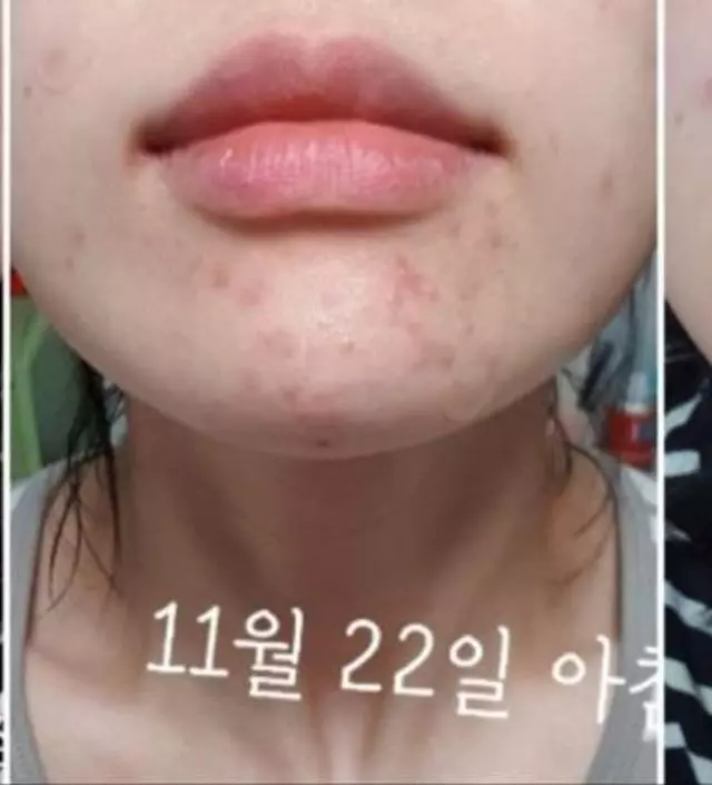 아침 저녁으로 발라준뒤 사진도 하루 아침 저녁으로 찍어서 정말 아이소이는 효과다 라