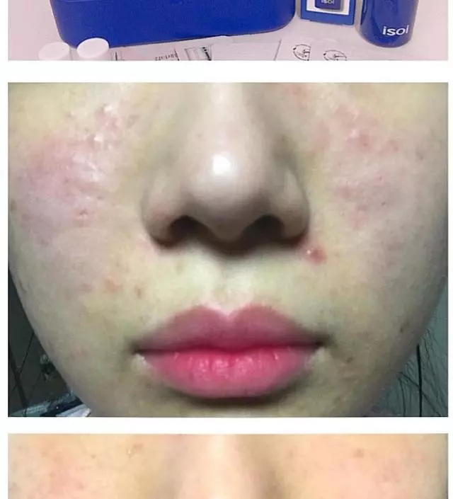 저는 얼굴 전체에 트러블이 나는 민감성 피부인데, 아이소이 잡티세럼을 사용한이후로 