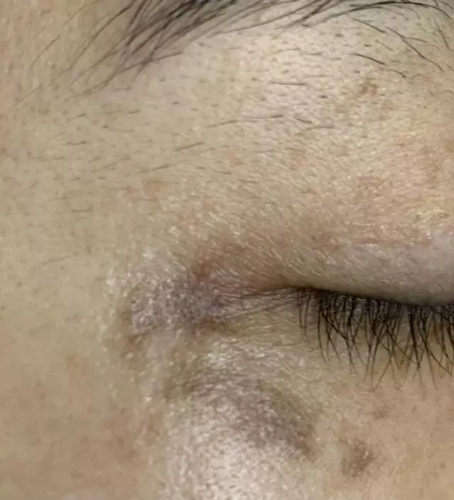 레이져 기미제거 시술이 잘못되어서 눈밑에 검은 상처마냥 피부가 검게 변했어요. 정말