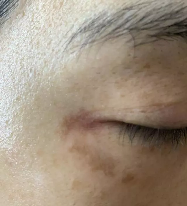 레이져 기미제거 시술이 잘못되어서 눈밑에 검은 상처마냥 피부가 검게 변했어요. 정말