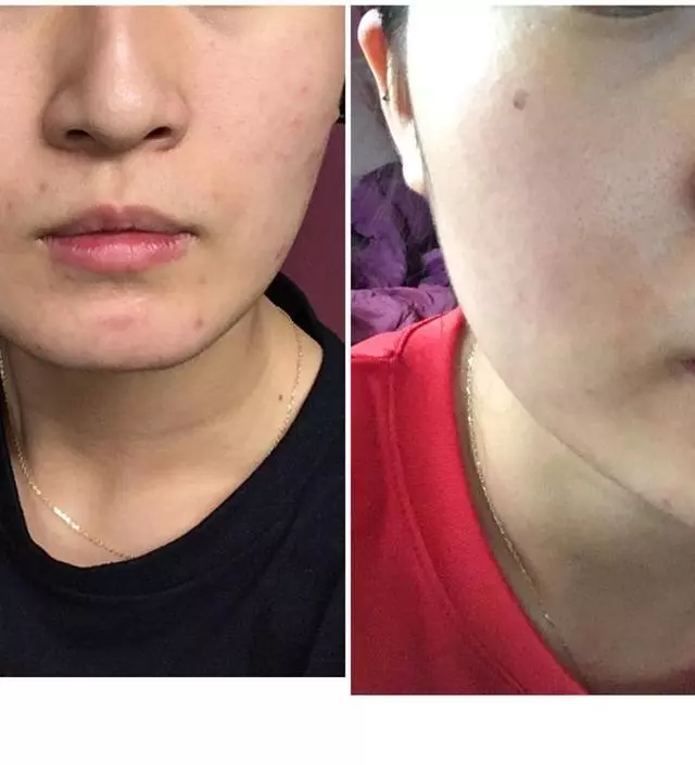 진짜 피부 뒤집어질 때로 뒤집어 져서 그냥 답 없을 때 있죠..? 
