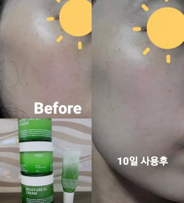 최근 피부에 자극이 가는 사건이 있었어요.  병원에서 재생크림 열심히 바르라는 말에 