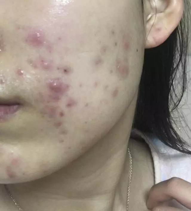 제가 진짜 피부여드름을 7년째 달고 사는데 이거 쓰고 진짜 많이 괜찮아졌어요 진짜 여