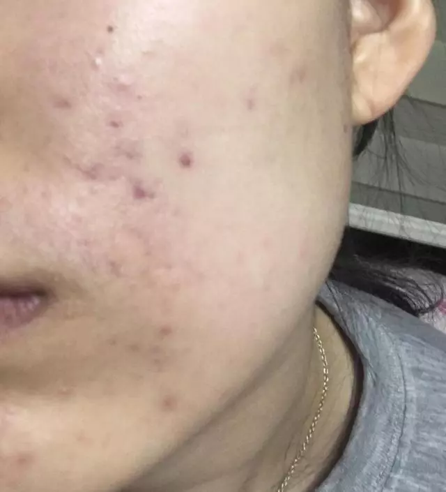 제가 진짜 피부여드름을 7년째 달고 사는데 이거 쓰고 진짜 많이 괜찮아졌어요 진짜 여